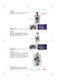 膵臓癌は現在でも早期発見が難しい癌であり、PET検査が膵