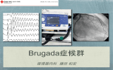 Brugada症候群