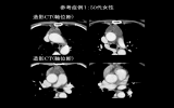 参考症例1：50代女性 造影CT(軸位断) 造影CT(軸位断)